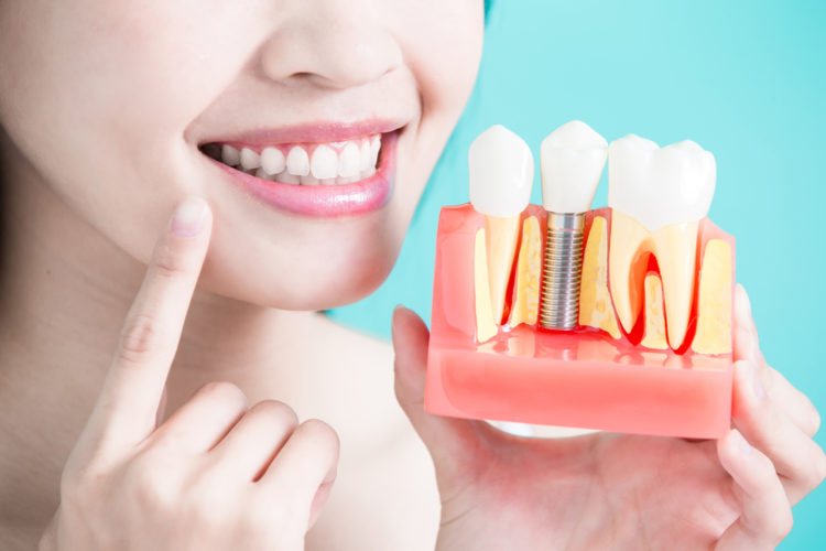 dental implants in south delhi