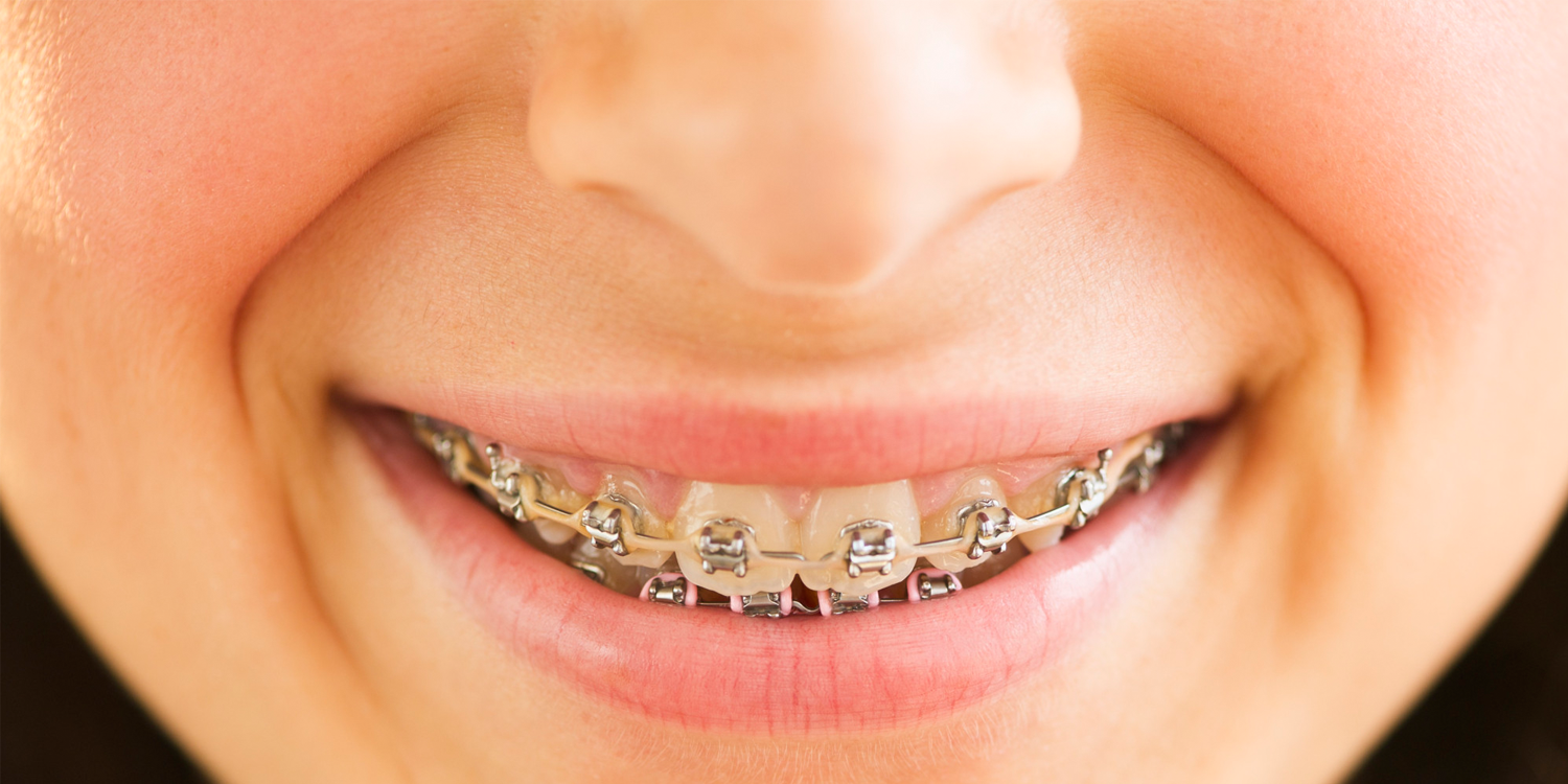 Understanding Orthodontic Treatment & Braces Green Park Dental