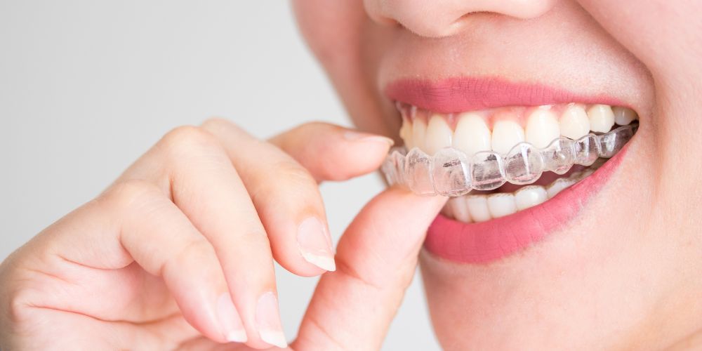 Everything You Need to Know About Straightening Your Smile