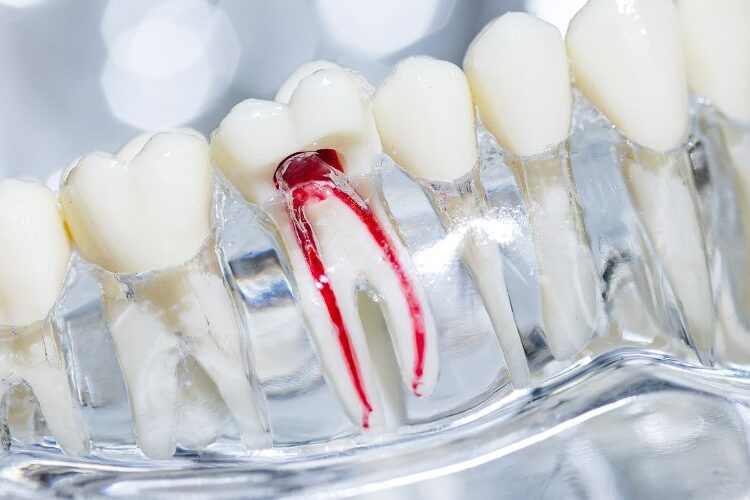 Root Canal Treatment