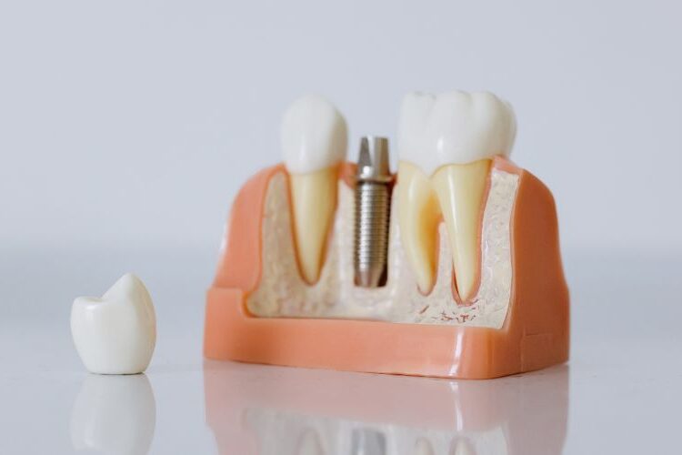 Dental Implants Cost